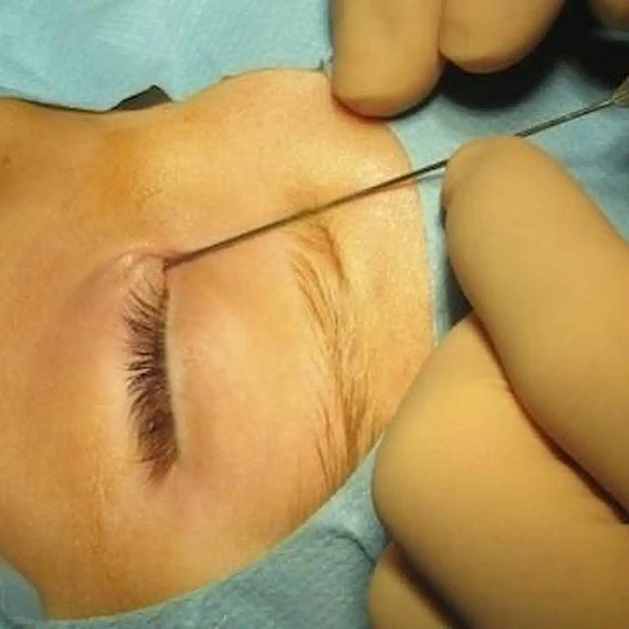 Chirurgie des voies lacrymales rabat centre ville hassan