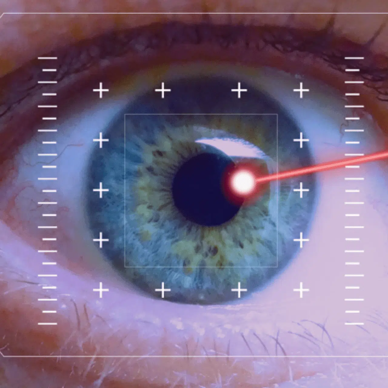 chirurgie de cataracte par phacoémulsification